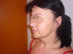 Face lifting surgery
