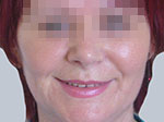 Face lifting surgery