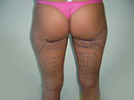 Buttock contour surgery