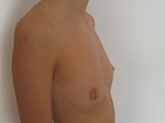 Brustvergrösserung in Ungarn