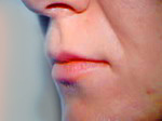 Lip enhancement plastic surgery